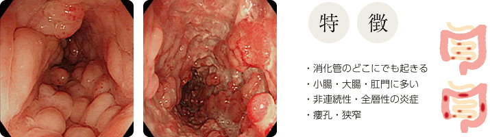 【特徴】・消化管のどこにでも起きる　・小腸・大腸・肛門に多い　・非連続性・全層性の炎症　・瘻孔・狭窄
